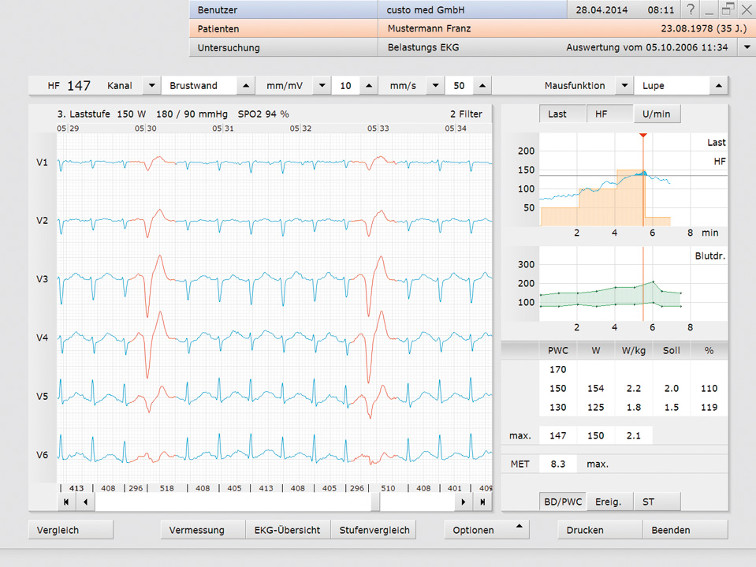 Belastungs EKG PC Software basierte Diagnostik Screenshot Darstellung custo med diagnostic